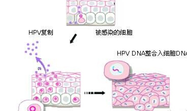 白癜风得治疗方法有哪些